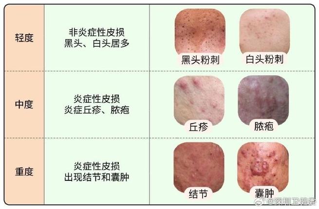 宫廷肤宝真的能祛痘吗？-图3