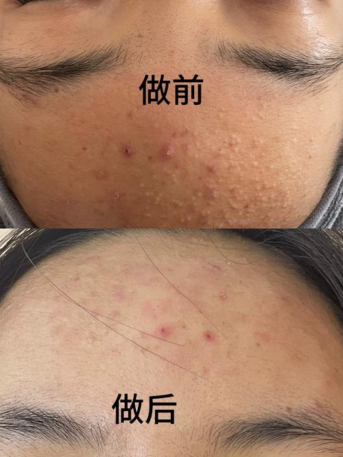 不花钱如何一夜快速祛痘？-图2