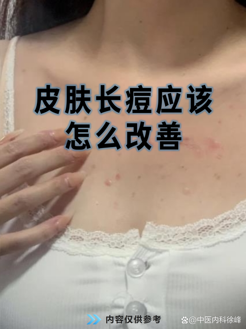 不花钱如何一夜快速祛痘？-图3