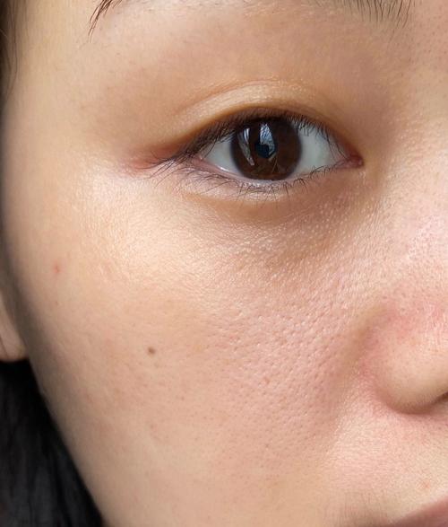 痘痘肌毛孔粗大，到底该选什么护肤品才能有效改善？-图2