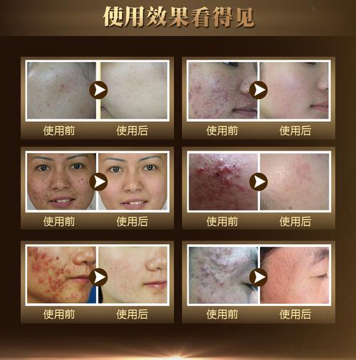 汉萱本草祛痘印真的有效吗？-图2