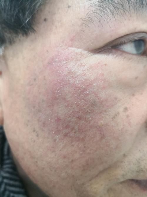 护肤品过敏有哪些症状？-图1