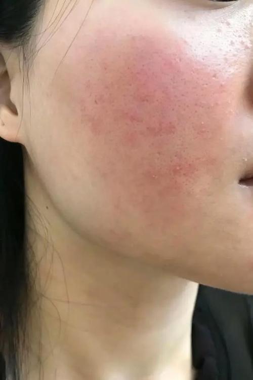 护肤品过敏有哪些症状？-图2