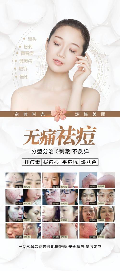 美容院祛痘印真的有效吗？-图3