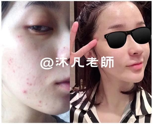 姿美堂祛痘效果怎么样-图3