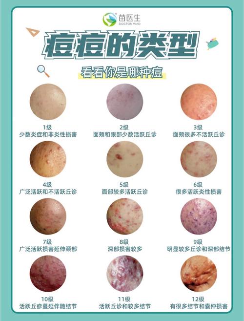 祛痘印费用因人而异吗？-图1