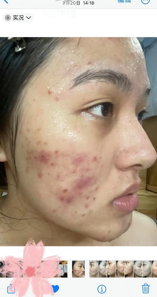 果汁小铺天然护肤为何会烂脸？-图1