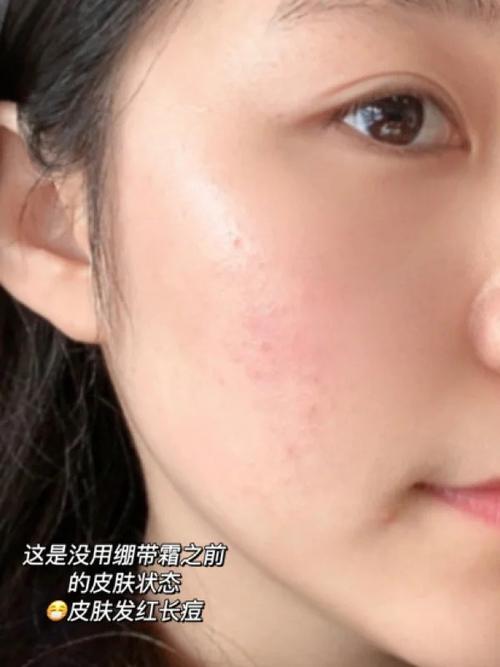 果汁小铺天然护肤为何会烂脸？-图3