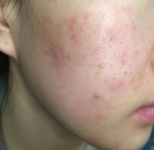 果汁小铺天然护肤为何会烂脸？-图2