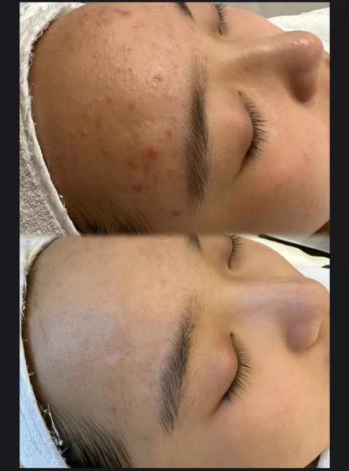 祛痘和美容院，该选哪个学？-图1