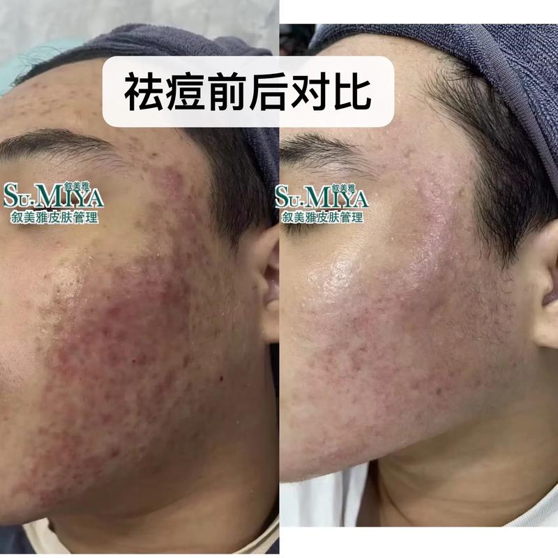 祛痘和美容院，该选哪个学？-图3