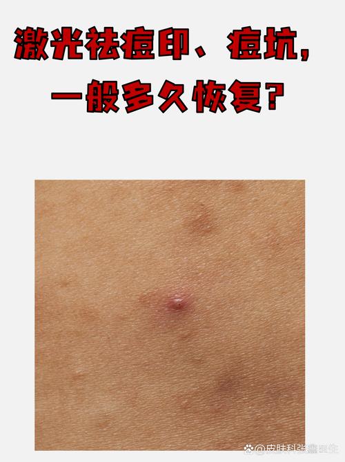 激光祛痘印要多久见效？-图3