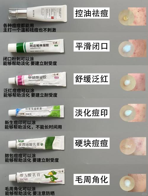 祛痘后该擦什么产品？-图2