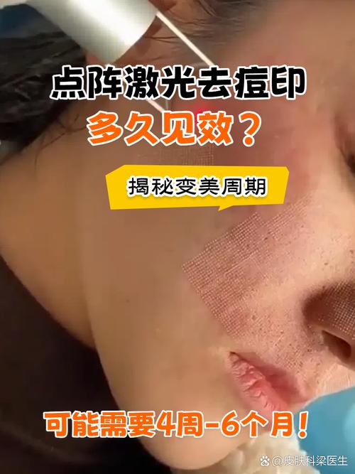 激光祛痘印一般需几次见效?-图1 激光祛痘印一般需几次见效?-图1