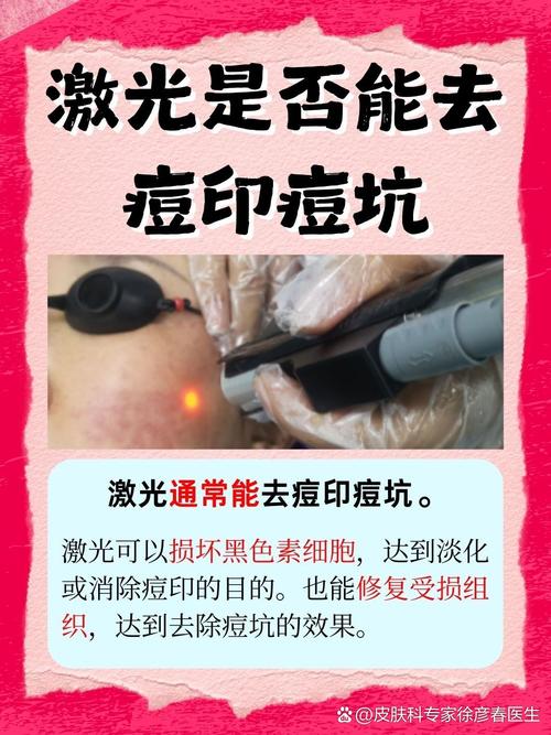 激光祛痘印一般需几次见效？-图2