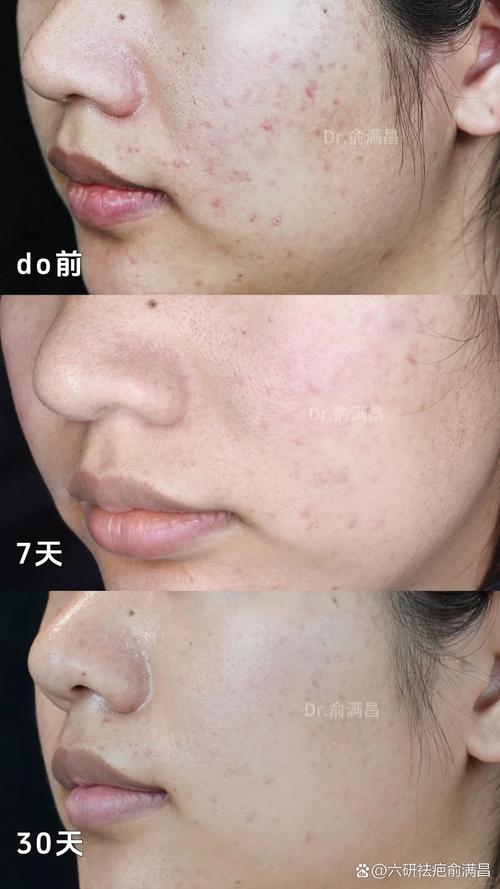 医院祛痘印效果真的好吗？-图1