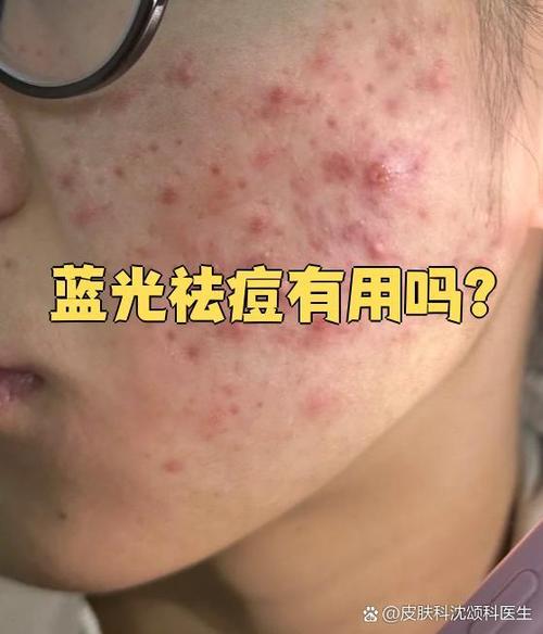 红蓝光祛痘印到底有没有效？-图2