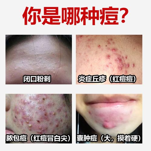 红霉素软膏祛痘会留疤吗？-图1