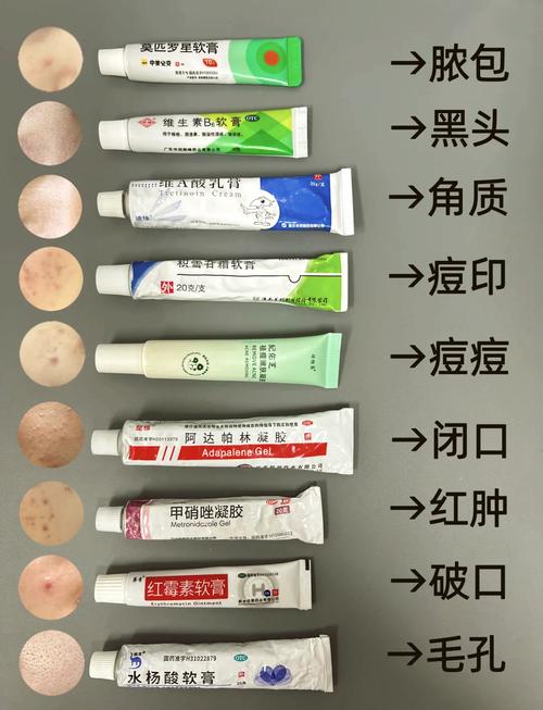 粉刺可以用祛痘产品吗-图1