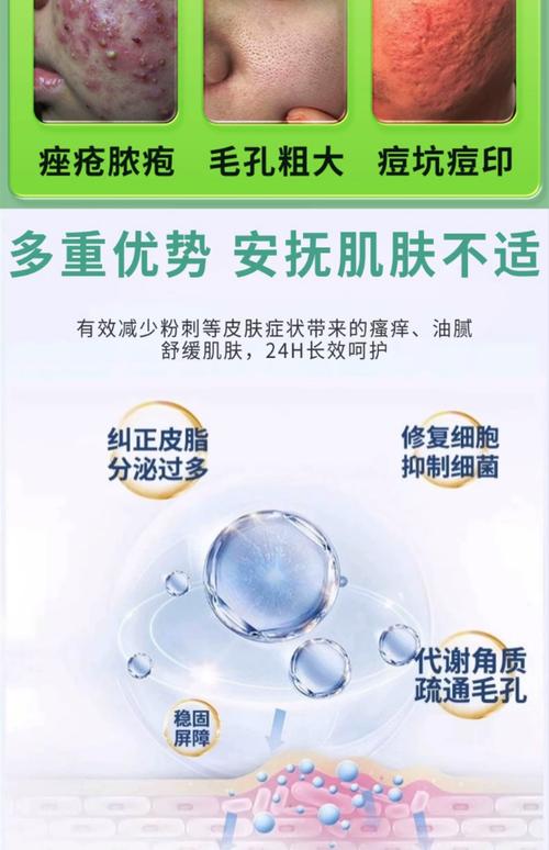 粉刺可以用祛痘产品吗-图3