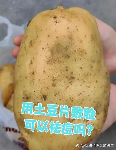 土豆敷脸多久能祛痘？-图2
