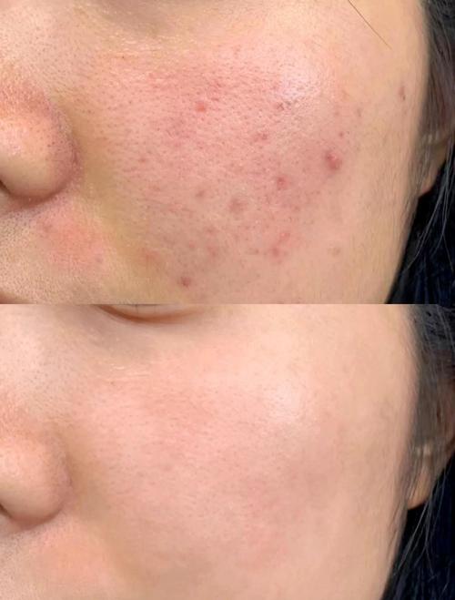 精油祛痘印真的有效吗？-图1