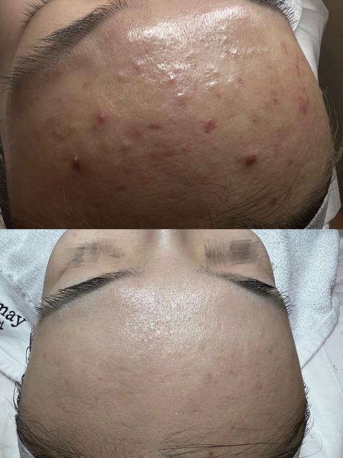 精油祛痘印真的有效吗？-图2