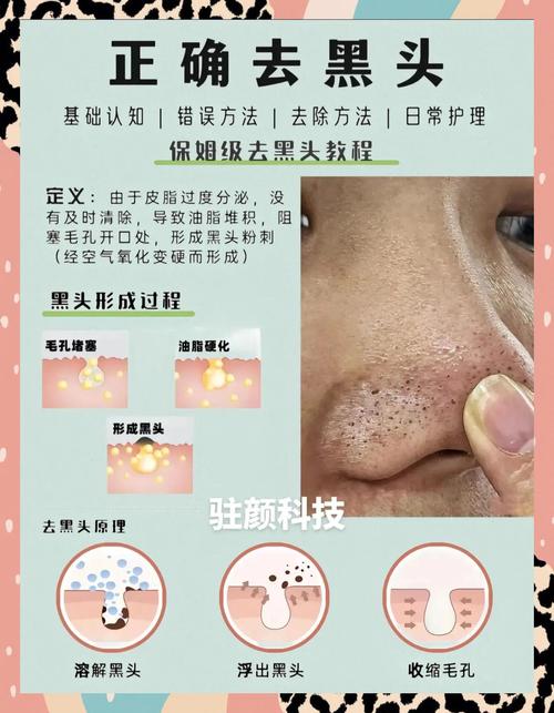 一天真能快速祛痘粉刺吗？-图2