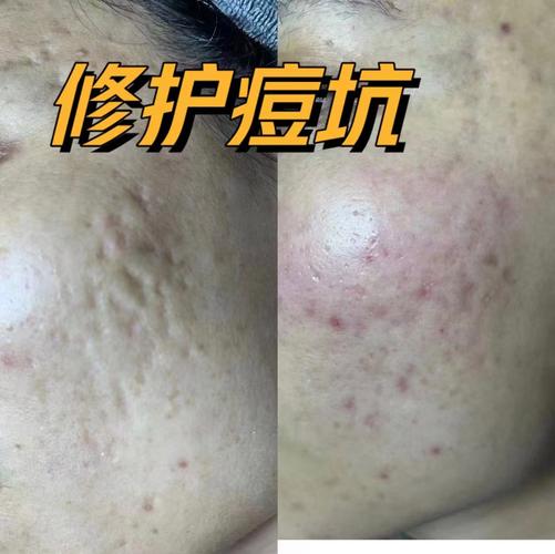 祛痘去中国安徽疤痕王-图1 祛痘去中国安徽疤痕王-图1