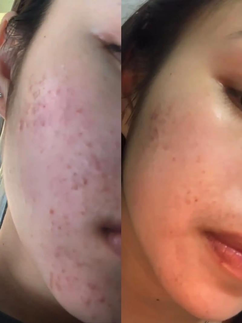 果酸祛痘印真的有效吗？-图1