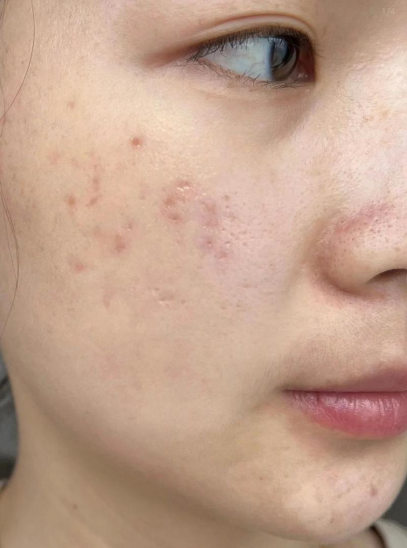 激光祛痘后效果真的好吗？-图1