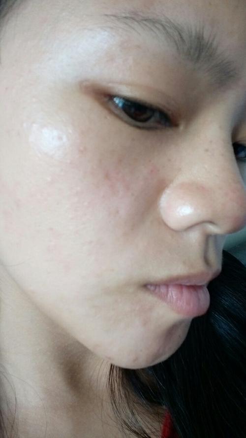 擦完护肤品脸反光,是营养过剩还是过敏了?-图2 擦完护肤品脸反光,是营养过剩还是过敏了?-图2