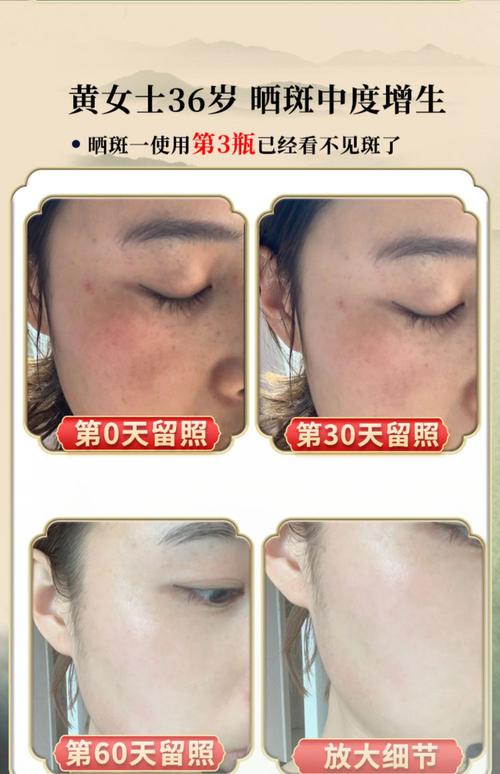 哪种护肤品祛斑效果最好？-图2