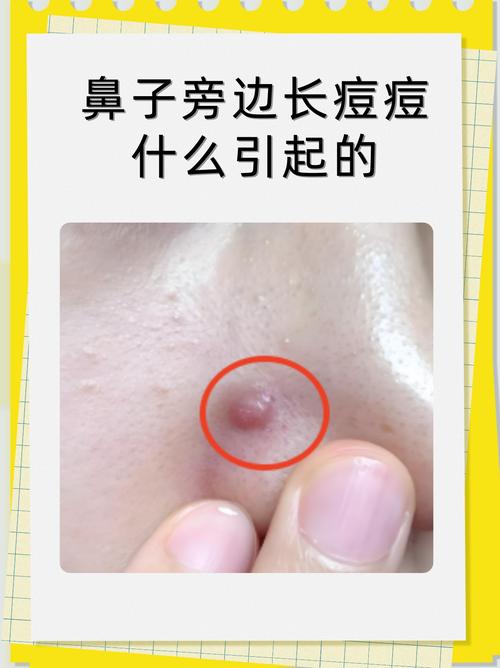 鼻梁长痘怎么快速祛除？-图1