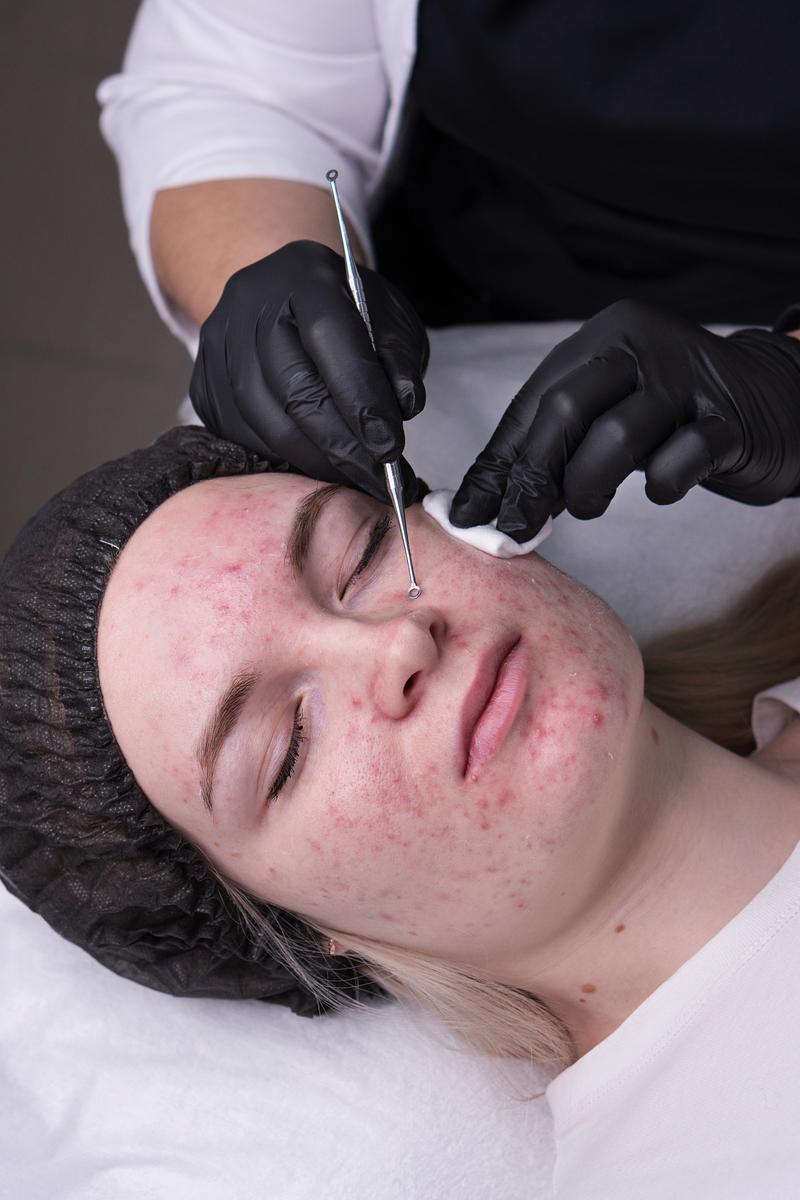 激光祛痘印会复发吗？-图2