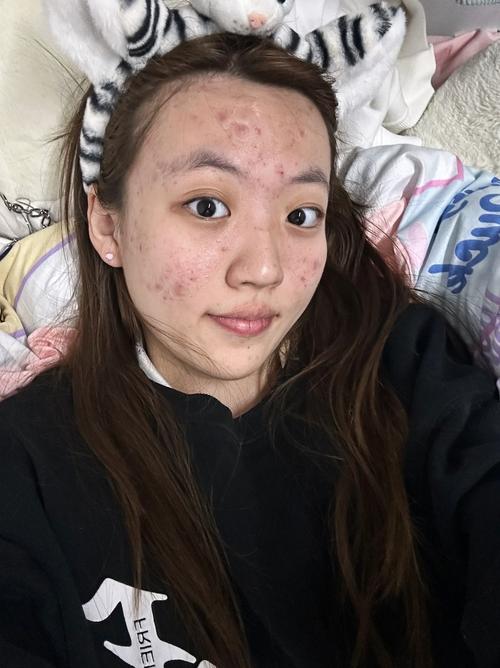 祛痘原液用后脸痒怎么回事？-图1