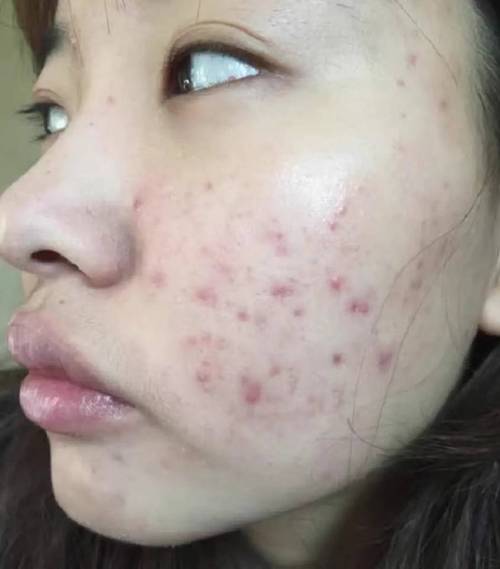 祛痘产品效果不佳怎么办？-图2