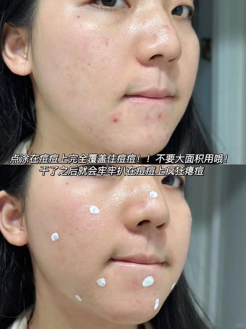 祛痘产品效果不佳怎么办？-图3