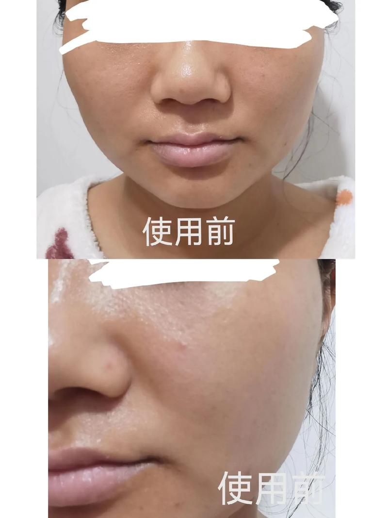 雅萌11蓝光祛痘效果到底怎么样？-图3