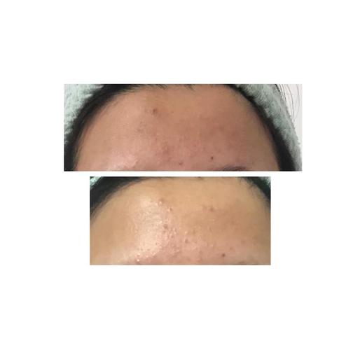 雅萌11蓝光祛痘效果到底怎么样?-图2 雅萌11蓝光祛痘效果到底怎么样?-图2