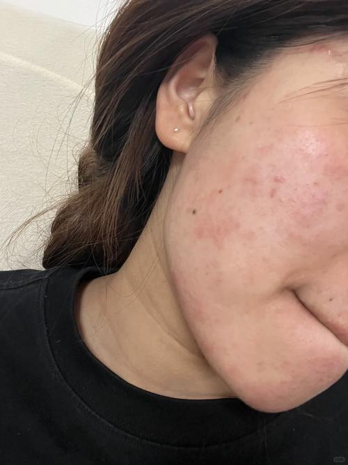 换护肤品后脸红，是过敏还是不适应？-图1