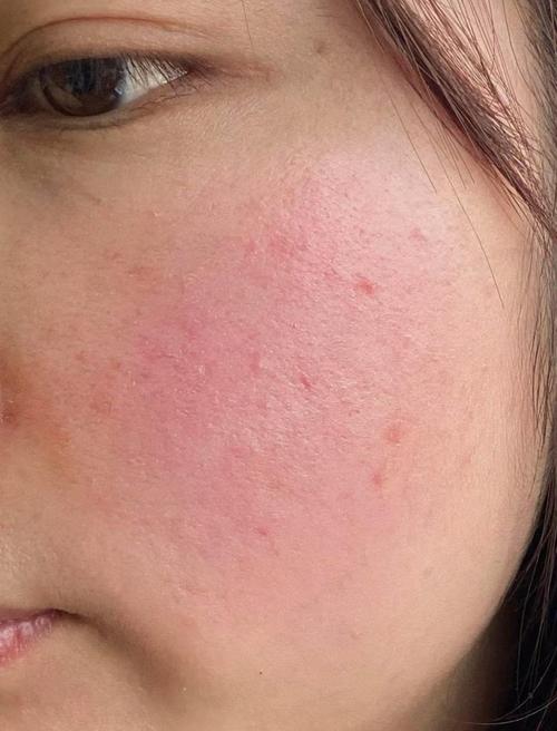 换护肤品后脸红，是过敏还是不适应？-图2