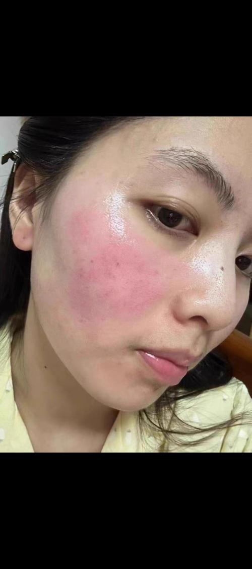 换护肤品后脸红，是过敏还是不适应？-图3