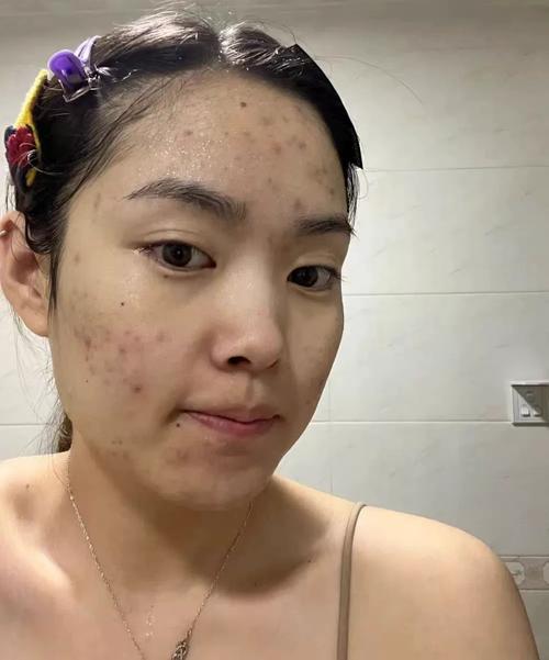 油皮祛痘真不用保湿吗？-图2