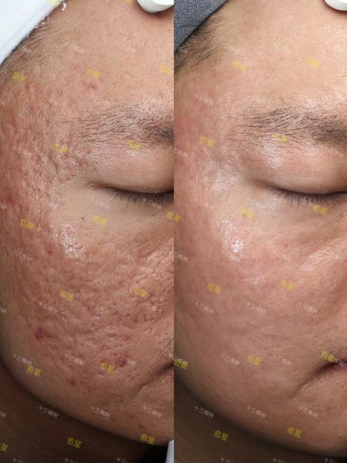 脉冲激光祛痘效果到底怎么样？-图2