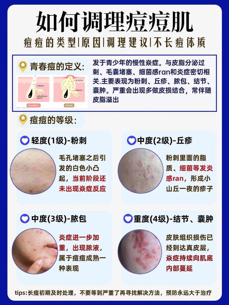 祛痘什么方法最有效？-图2