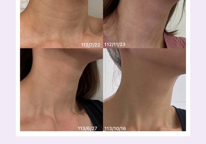 脂肪填充后护肤品怎么选？-图1