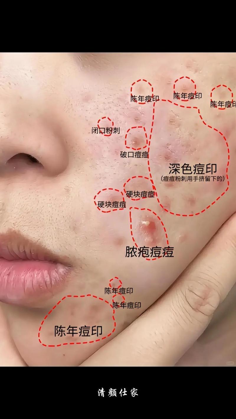 祛痘留痘印？美容院有风险吗？-图2