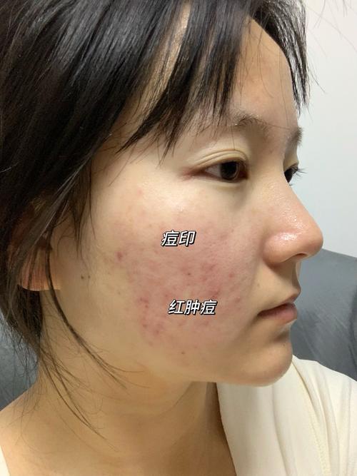 祛痘留痘印？美容院有风险吗？-图3