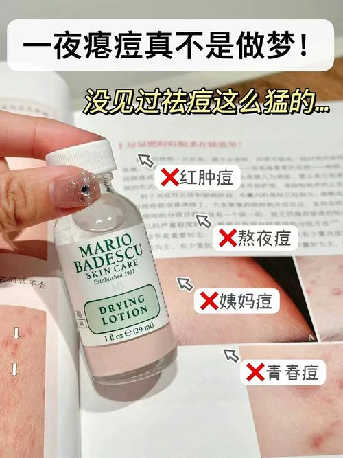 闭合性粉刺护肤品选哪个？-图3